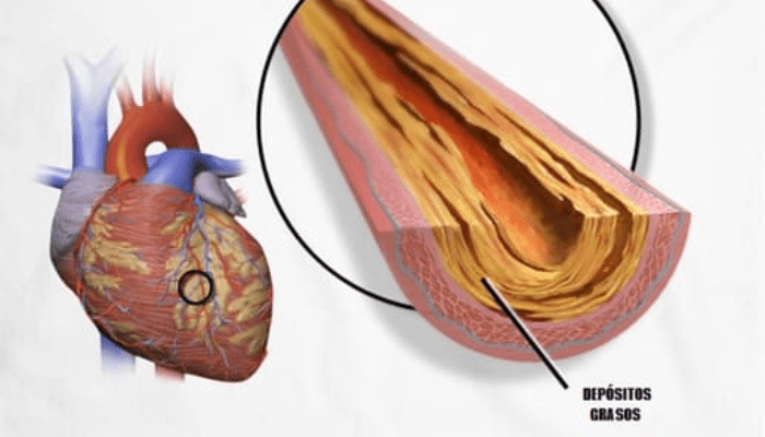 ¿Cómo afecta la presión arterial alta a la salud cardiovascular?